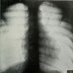 Rhinomer F 2 Med Limpieza Nasal Nebulizador 1